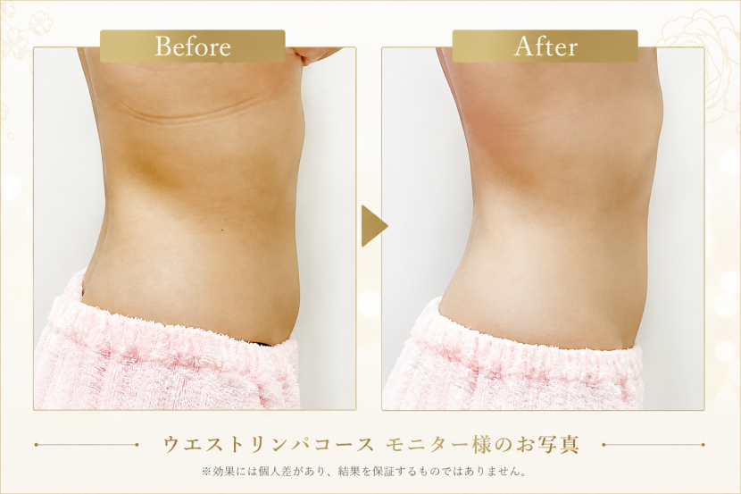 美しいボディラインを目指して― ウエストリンパコース―